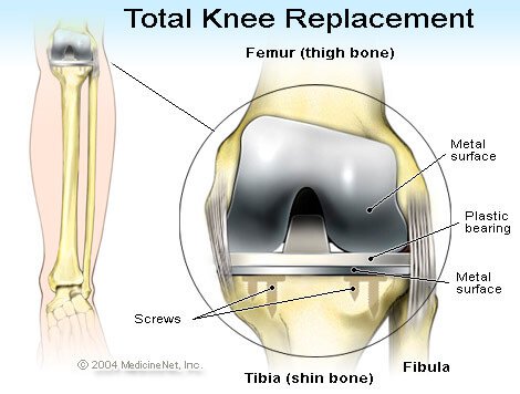 Answers to Common questions about knee replacement surgery, best knee replacement hospital in Chandigarh.