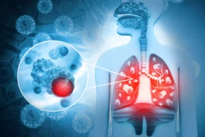 cancer specialist surgeons in Ambala state that there are no well-defined causes of lung cancer