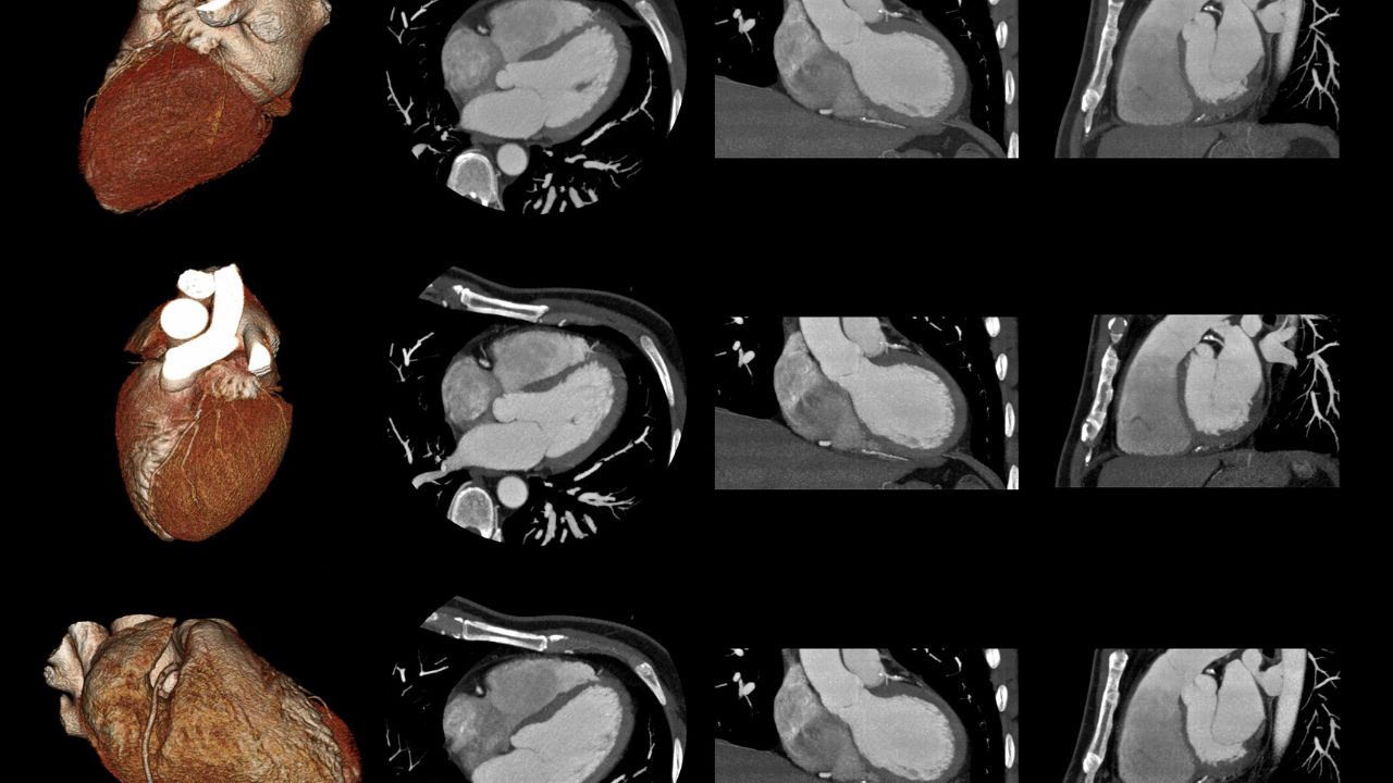 Types Of Angiography