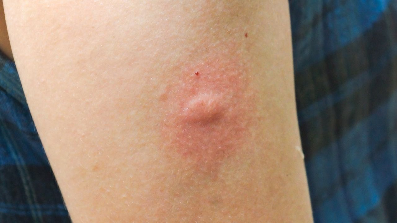 Is Scrub Typhus Curable?

