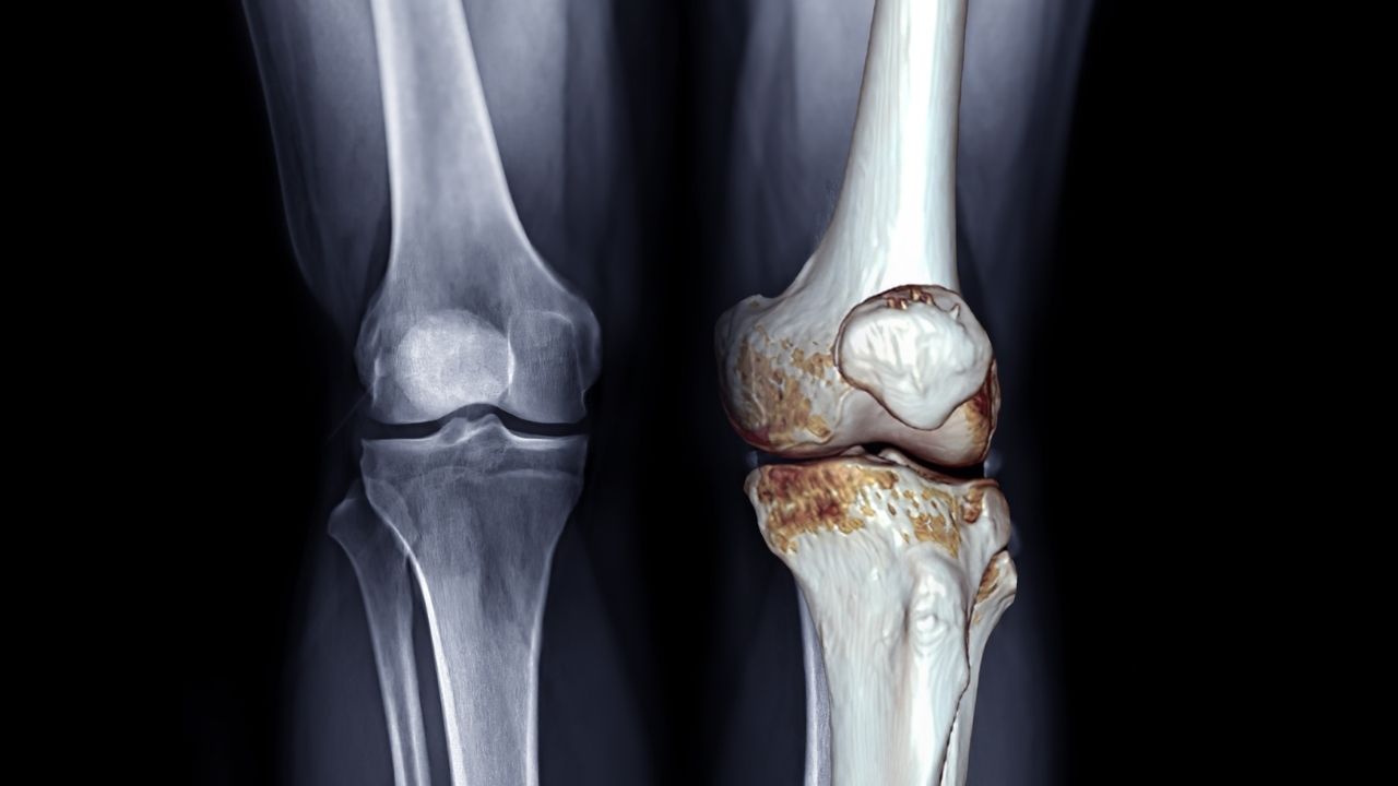 How to Prepare for Partial Knee Replacement Surgery
