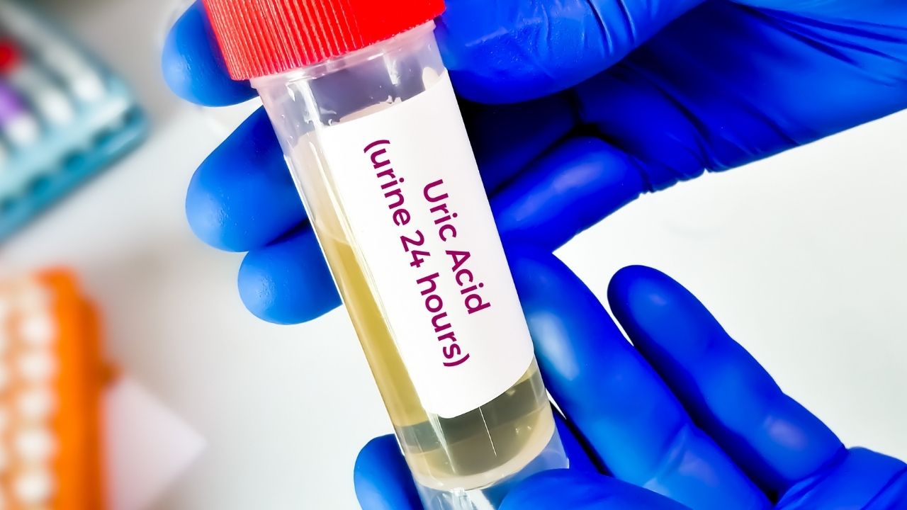 What are the Symptoms of High Uric Acid in the Body