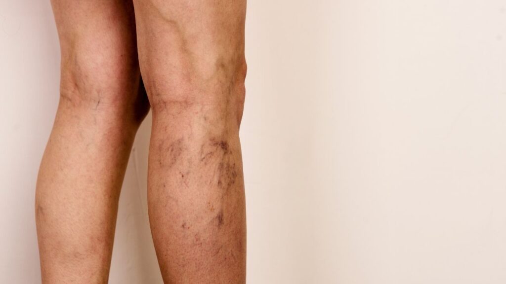 Best Varicose Veins Treatment in Chandigarh