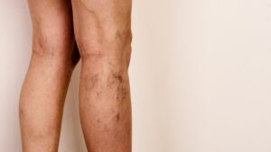 Best Varicose Veins Treatment in Chandigarh