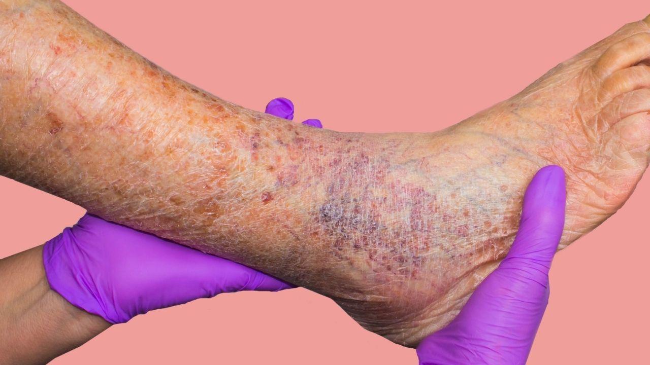 What Are The Causes Of Varicose Veins